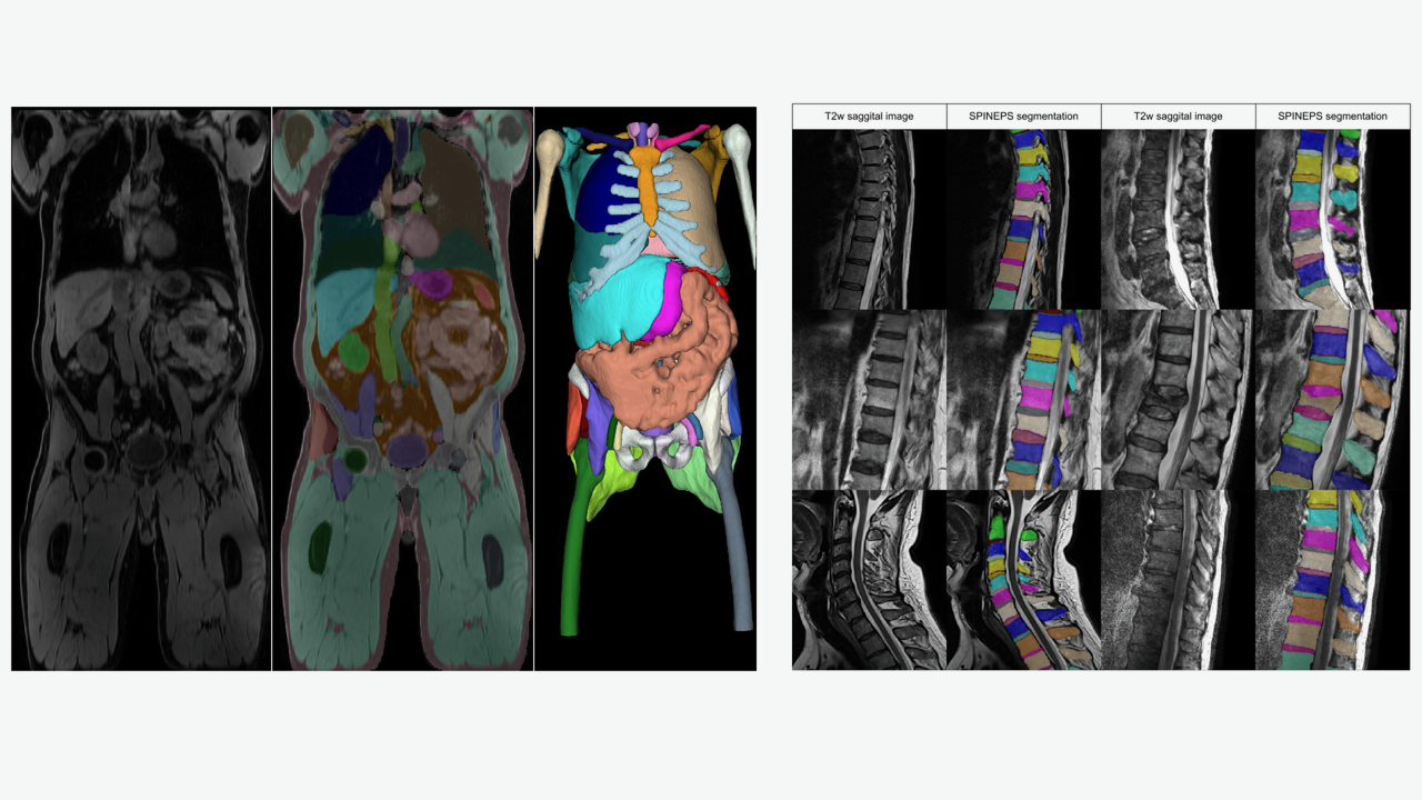 One of the main focuses of our research is the use of deep learning approaches for the segmentation of biomedical images (e.g. left: whole body segmentation, right: spine segmentation from MR images) © 
