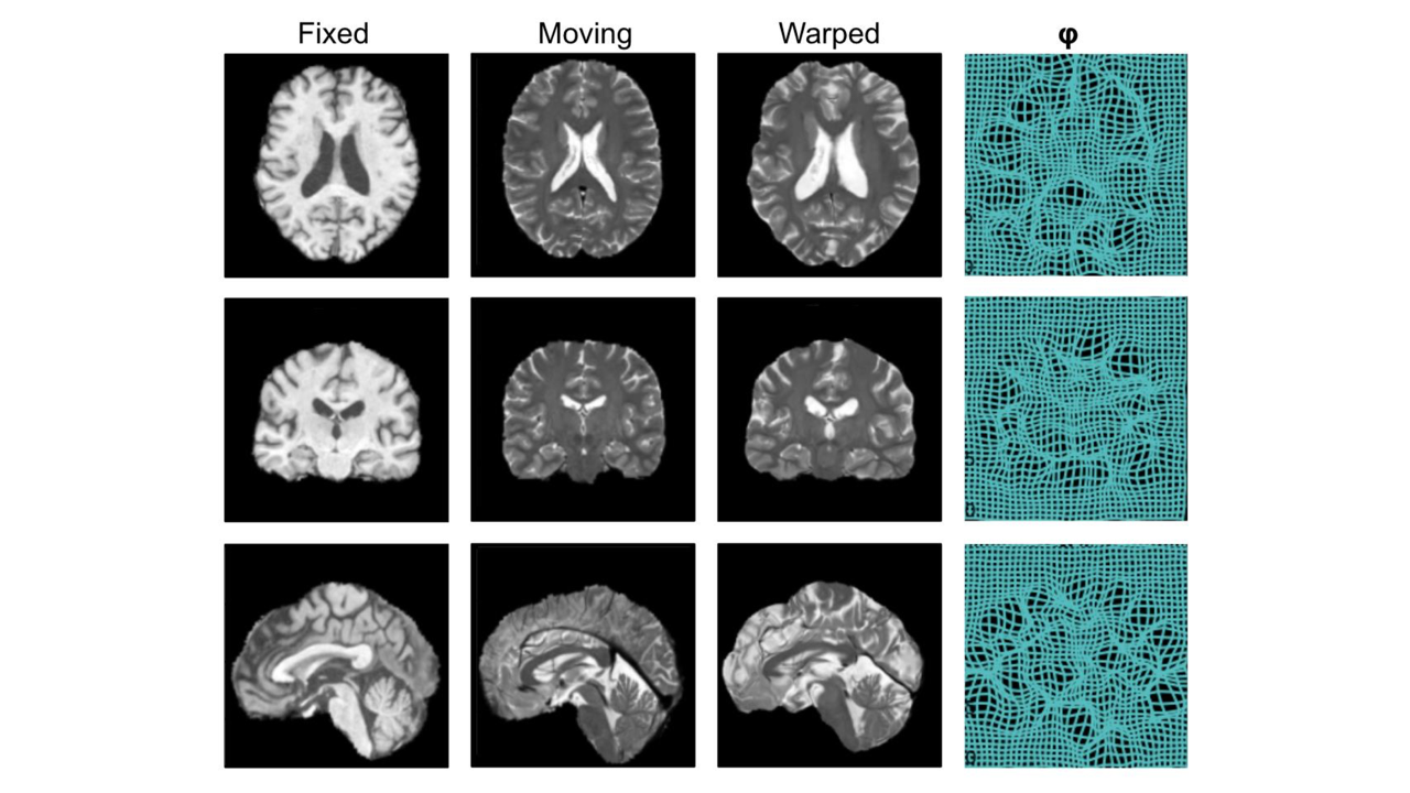 Image registration is an essential task in medical image analysis. One of our research directions are exploring the use of ML for accurate, robust and efficient image registration. Here for example a pair of T1-weighted and T2-weighted brain MR images being registered using implicit neural representation of deformation. © 
